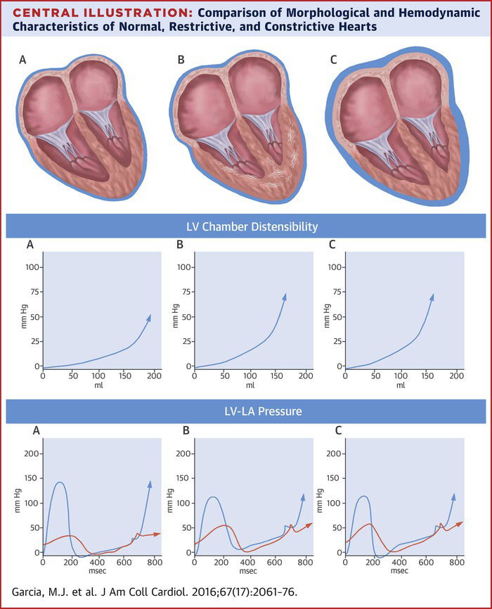 Pericardial diseases