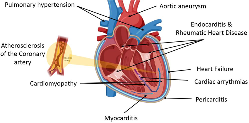 Basics of Miscellaneous Cardiovascular Lesions