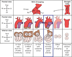 Basics of Anomalies of Ventricular Arteries & Great Arteries